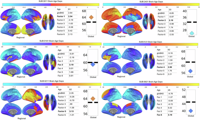 Fig. 5: Individualized patterns of brain aging revealed by factor scores.