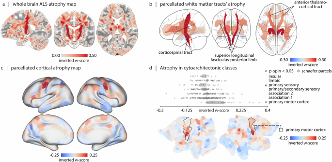 Fig. 1: ALS-related white matter and grey matter atrophy.