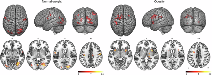 Fig. 2: Functional connectivity under stimulation versus resting state in individuals with normal-weight and in individuals with obesity indicating a shift from attentional to salience network activation when centering the thalamus.