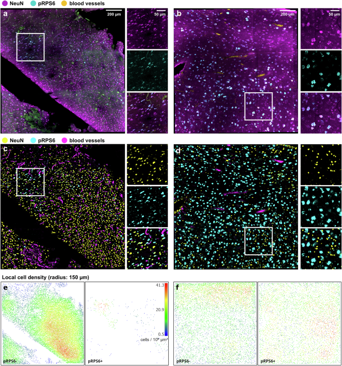 Fig. 3: Volumetric imaging with TPFM and analysis on surgically removed pediatric brain specimens.