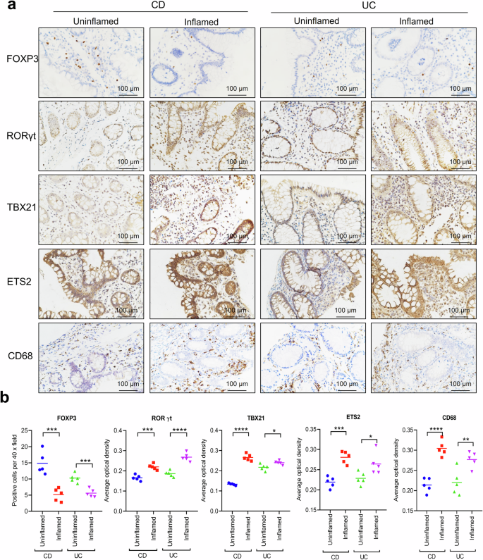 Fig. 2: ETS2 increasingly expressed in diseased intestinal tissues of CD and UC children.