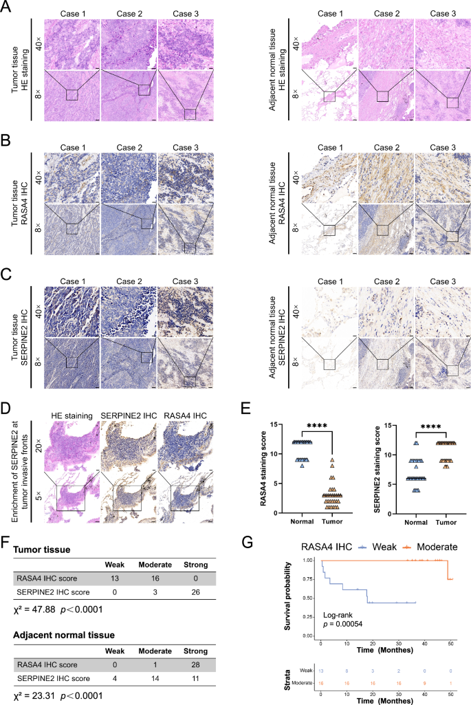 Fig. 6: RASA4 is down-regulated in SCLC tumor tissues and correlates with poor clinical prognosis.