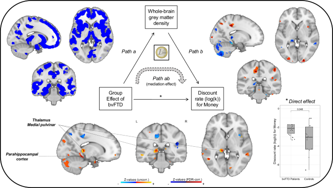 Fig. 4: Neuroanatomical whole-brain mediators for the effect of bvFTD on discounting of monetary rewards.