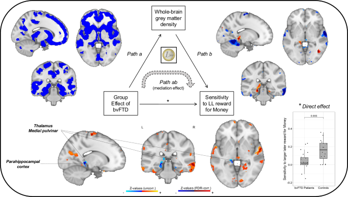 Fig. 5: Neuroanatomical whole-brain mediators for the effect of bvFTD on sensitivity to larger later monetary reward.