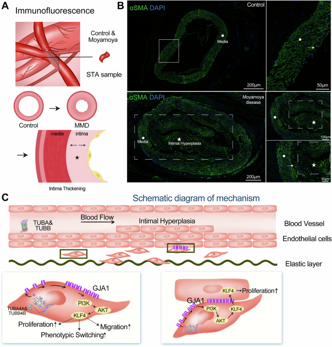 Fig. 2: Immunofluorescence staining of intimal thickening in MMD vessels and the underlying mechanism.