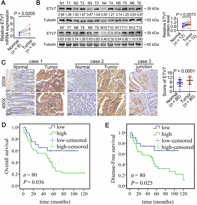 Fig. 1: High expression of ETV7 predicts poor prognosis in colorectal cancer patients.