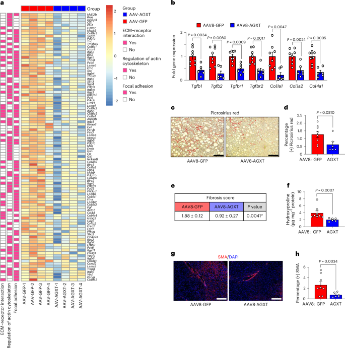 Fig. 6: Oxalate lowering via AGXT overexpression decreases hepatic fibrosis in MASH.