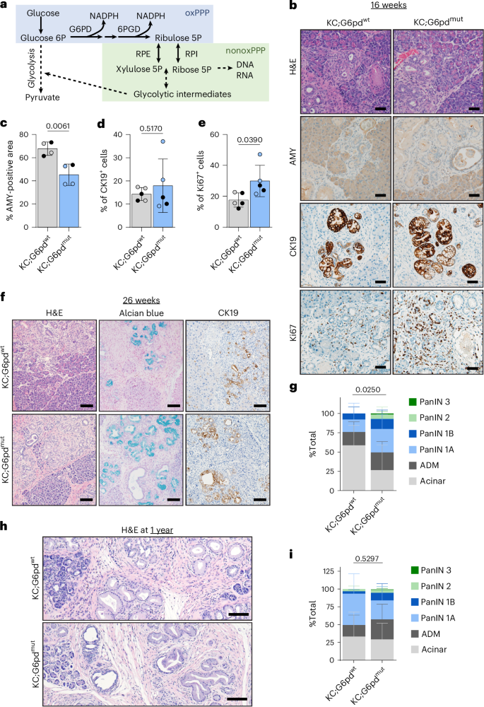 Fig. 2: G6PD deficiency accelerates ADM and PanIN.