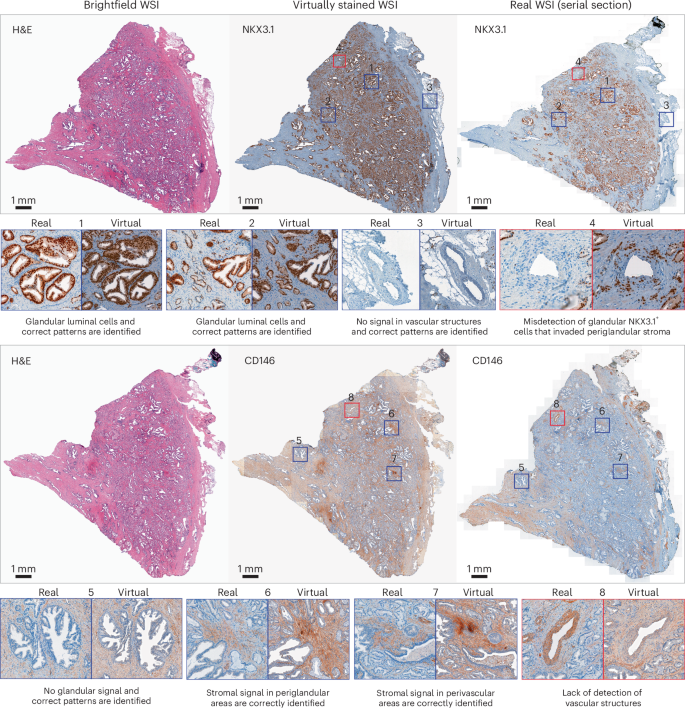 Fig. 4: Transfer learning from TMA to WSIs of prostate cancer tissue.