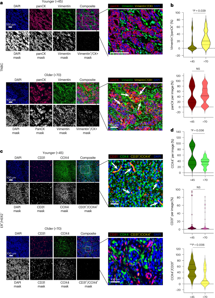 Fig. 4: mIF analysis of tumors from younger and older patients with TNBC and ER+/HER2− breast cancer.