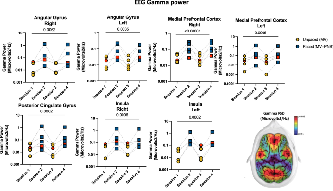 Fig. 1: Phrenic nerve increases EEG gamma frequency in deeply sedated mechanically ventilated patients.