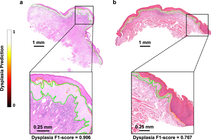 Fig. 2: Dysplasia segmentation heatmap using the ODYN model.