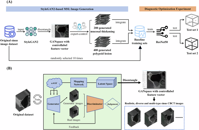Fig. 1: The study design flowchart and the structural diagram of the StyleGAN2-based MSL generation tool. A Expert-controlled StyleGAN2-generated lesion images were incorporated into the baseline training set to improve data distribution, followed by evaluating ResNet50’s diagnostic performance. B After training StyleGAN2, high-quality MSL images, like mucosal thickening, polypoid lesions, and ostium obstruction, could be generated through an expert-controlled GANSpace interface.