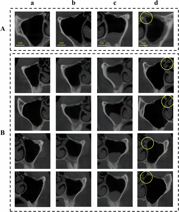 Fig. 3: The condition of generated maxillary sinus images. Box A contained real maxillary sinus images, while box B contained generated images. Columns a, b, c, and d represented normal maxillary sinus, mucosal thickening, polypoid lesion, and ostium obstruction, respectively (with the yellow circles indicating obstruction location). The first two lesion types were included in diagnostic optimization experiments. These results demonstrate successful generation of realistic, diverse, and multi-type maxillary sinus images.