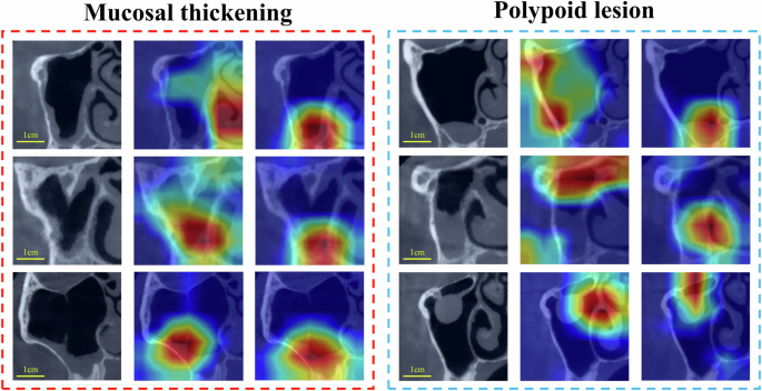 Fig. 4: Grad-CAM visualizations of ResNet50 before and after StyleGAN2-based dataset optimization. For the two types of lesions, three images were randomly selected from Test Sets 1 and 2 for demonstration. From left to right, columns showed: original test images, ROI before dataset optimization, and ROI after dataset optimization (yellow circles indicated the approximate lesion locations). It was evident that incorporating generated images to optimize the baseline training set enhanced model focus more on lesion areas, thereby improving the reliability of the prediction results.