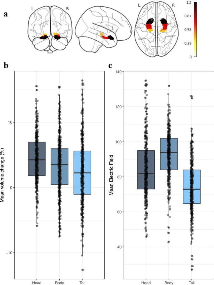 Fig. 1: Hippocampal longitudinal axis volumetric changes following electroconvulsive therapy and the hippocampal electric field strengths.
