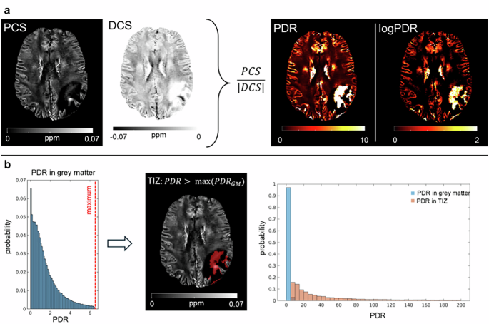 Fig. 2: PDR uniquely identifies the “TIZ” in edema.