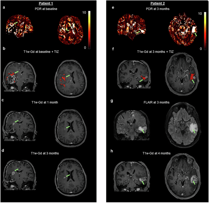 Fig. 4: PDR suggests tumor infiltration.