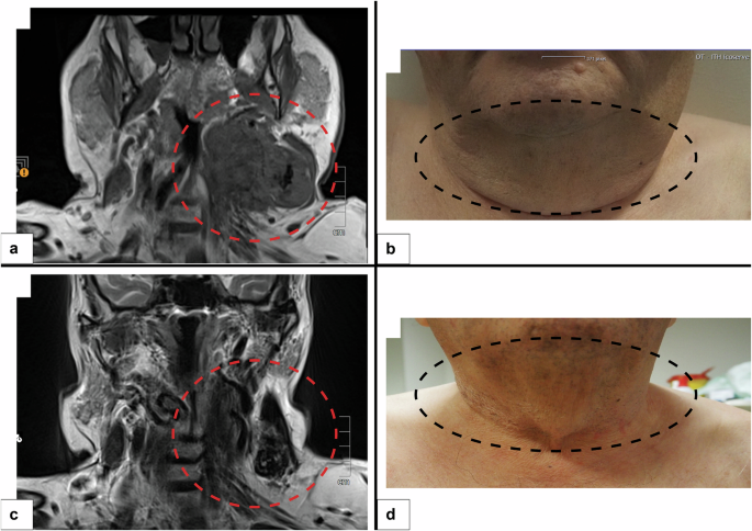 Fig. 2: Clinico-radiological correlation of the disease course.