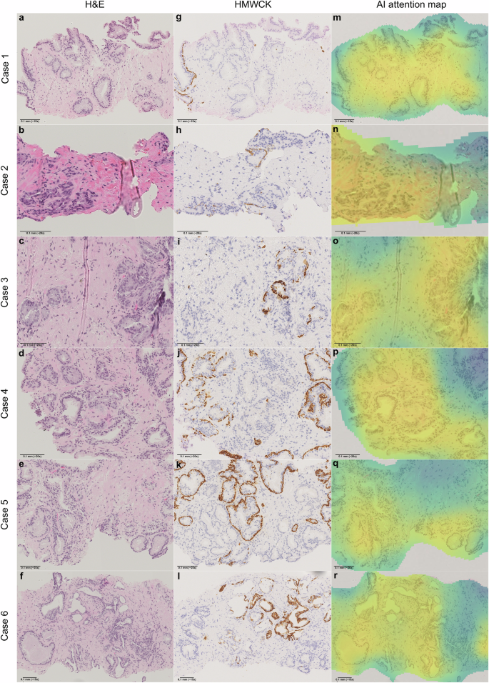 Fig. 3: False negative predictions with low-grade morphologies from the SUH cohort.