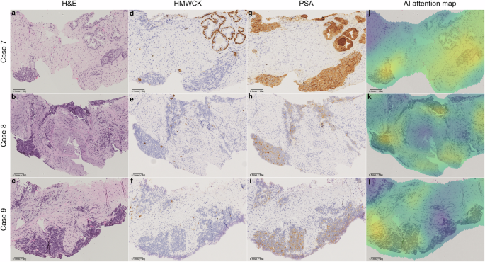 Fig. 4: False negative predictions with high-grade morphologies from the SUH cohort.