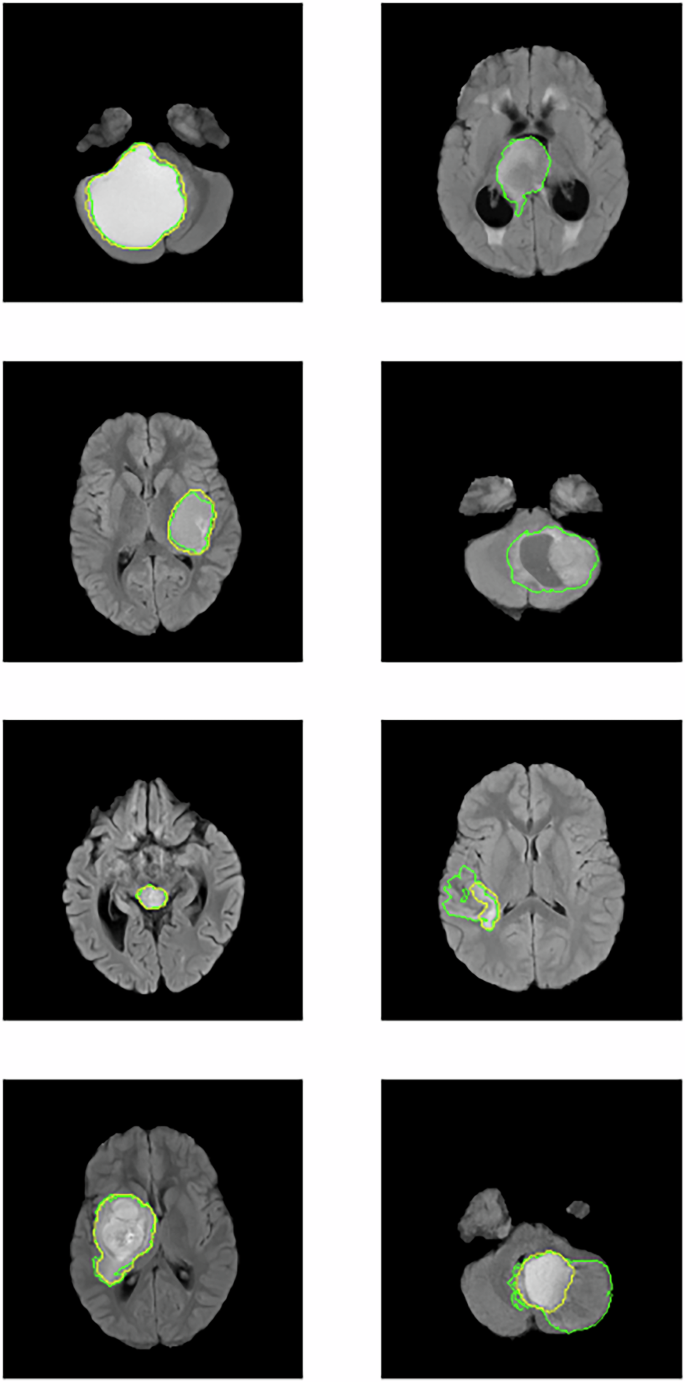 Fig. 5: Preprocessed images for 8 patients, with both automated (yellow) and semiautomatic whole tumor volume (green) segmentations. Similar to what has been found in previous works, our model works well for some patients (left) but fails in certain cases (right).