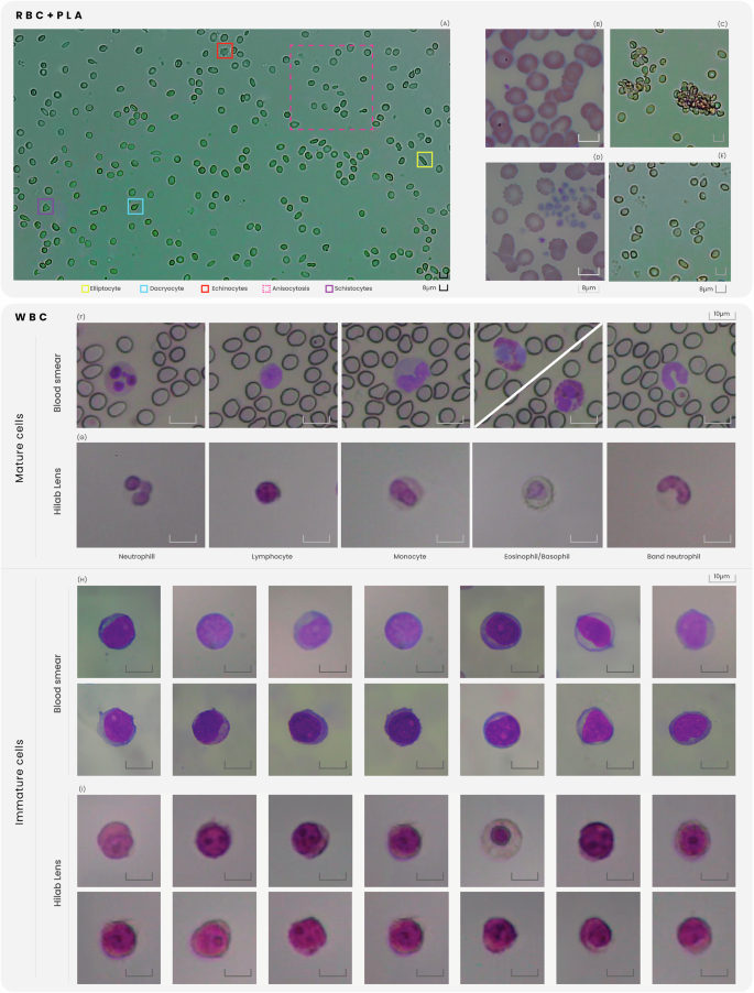 Fig. 4: Comparison between Hilab Lens (HL) and standard blood smear methodology (BS) for flagging study.