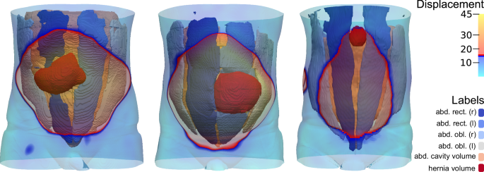 Fig. 2: Overlay of the unstable abdominal wall on the segmentation results.