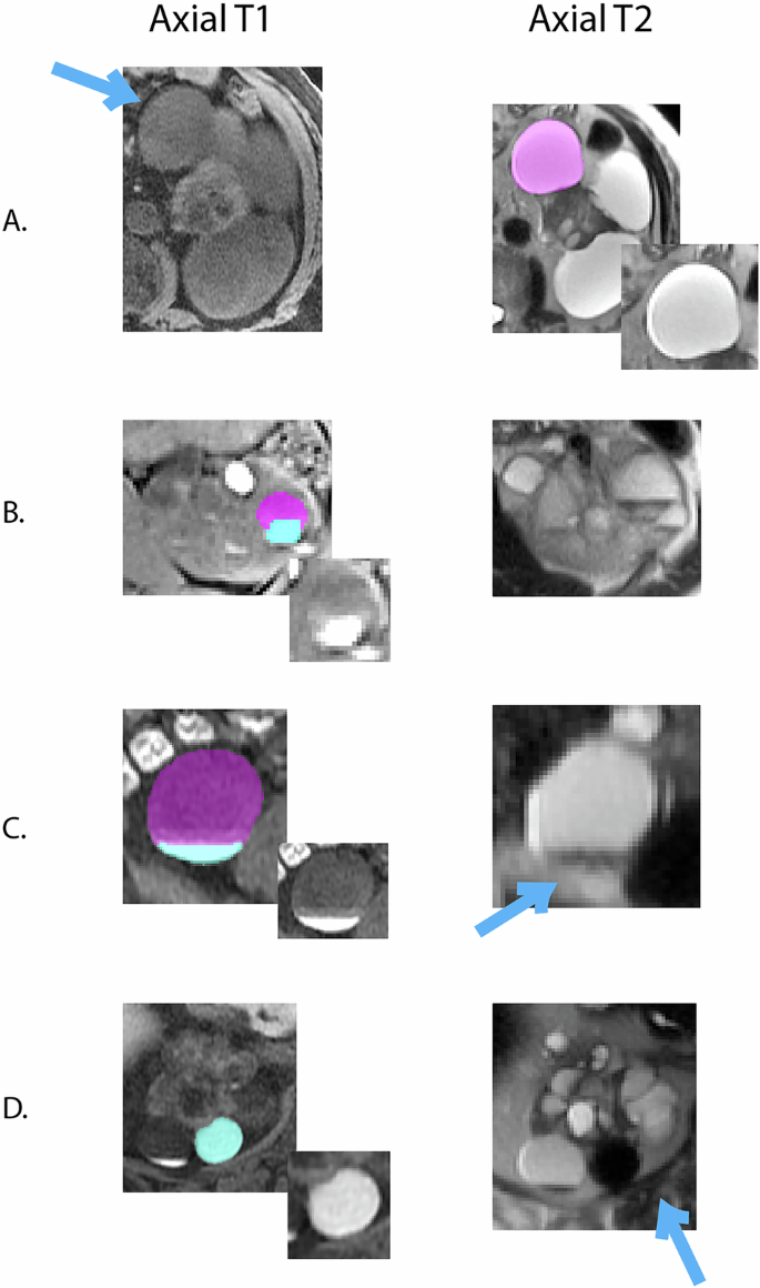 Fig. 1: Characterization of ADPKD cyst type based on MRI appearance.