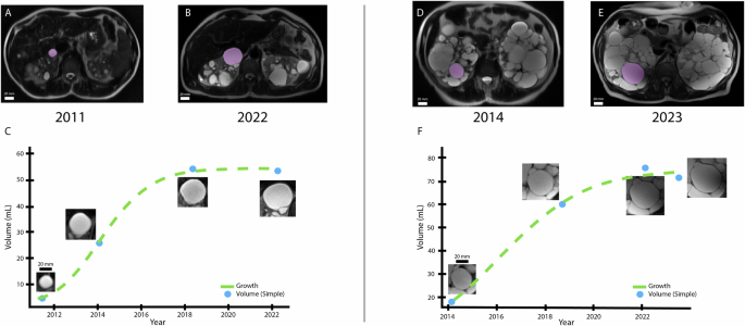 Fig. 2: Two examples of simple cysts (pink) following logistic growth (Cyst 1: A-C, Cyst 2: D-F).