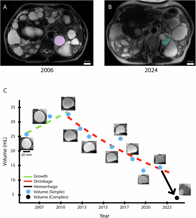 Fig. 3: Trajectory of a simple cyst growing, shrinking, and eventually transitioning into a complex cyst.