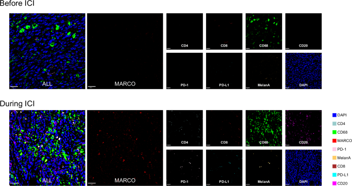 Fig. 7: Multiplex immunofluorescence of samples from a clinically benefited case (KM041) before and during ICI treatment.
