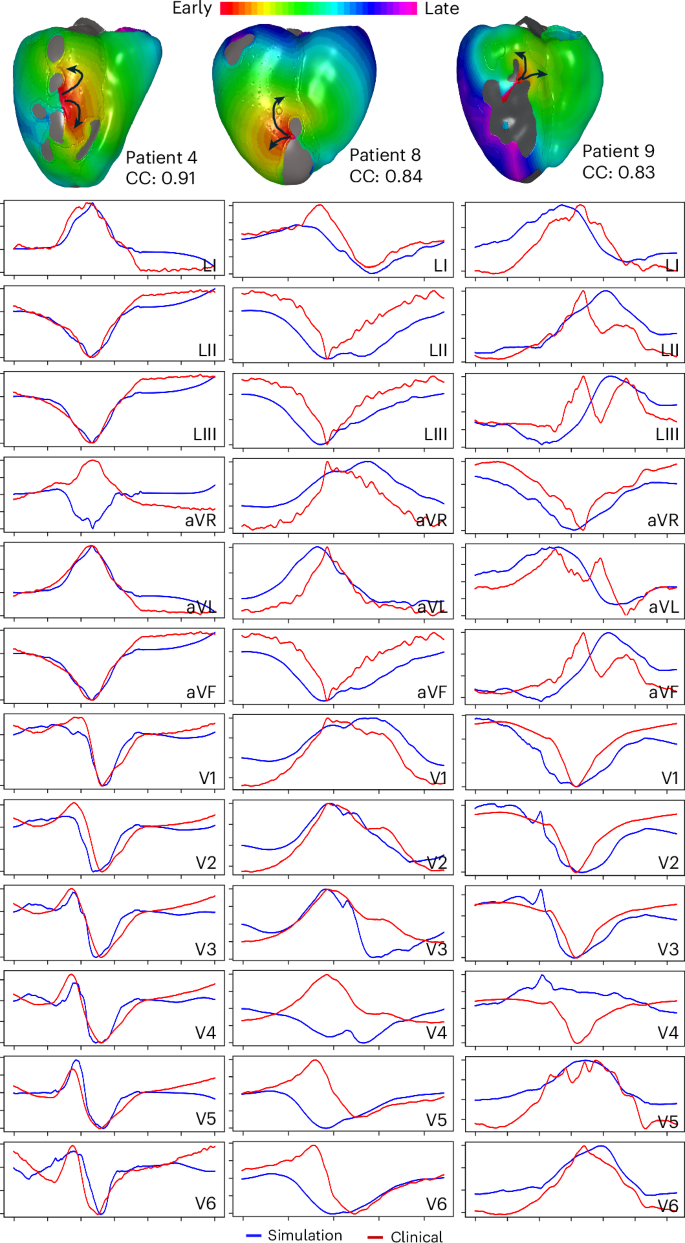 Fig. 4: Simulated activation maps and ECG comparisons for three patients at maximum CC value.