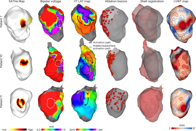 Fig. 6: Comparison of SATHe Maps with bipolar voltage map, ablation lesions and LAT maps of VT circuits for three patients.
