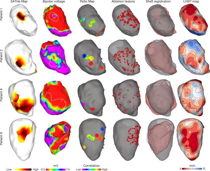 Fig. 7: Comparison of SATHe Maps with bipolar voltage map, ablation lesions and PaSo Maps for four patients in whom VT mapping was not possible.