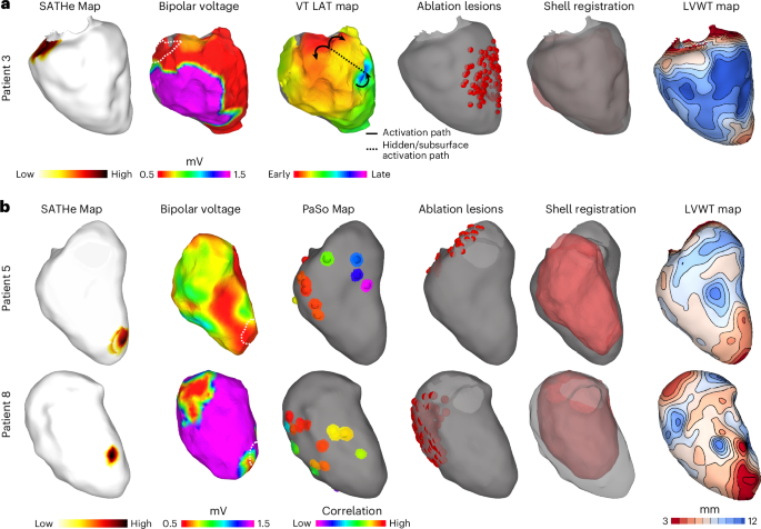 Fig. 8: Comparison of SATHe Maps with clinical data in the three patients with relatively little pathologically thinned LV wall.