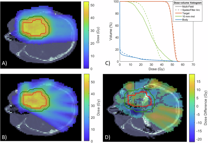 Fig. 7: The dose distributions delivered with proton arc and a SpeleoFilter can achieve similar plan qualities compared to intensity modulated proton therapy (IMPT).