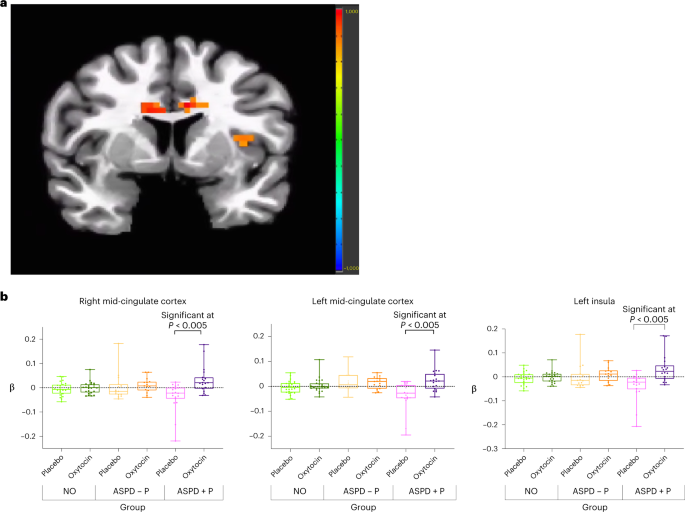 Fig. 2: Effect of oxytocin in ASPD + P.