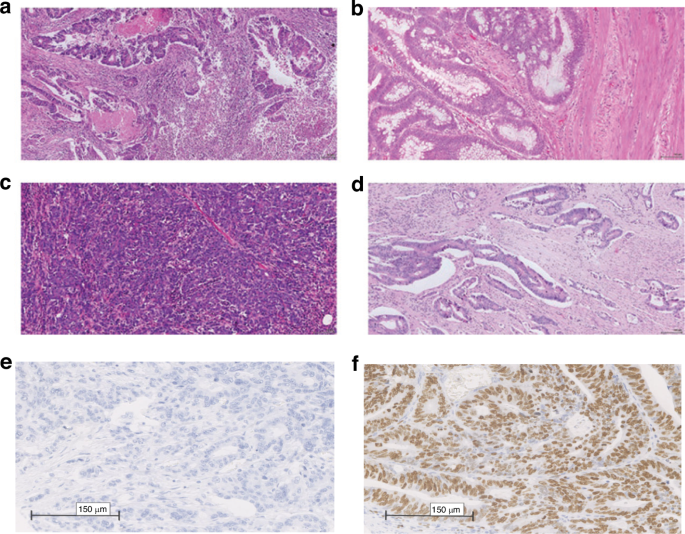 Fig. 2: Assessment of tumour inflammatory cell infiltrate and TSP on H&E-stained sections.