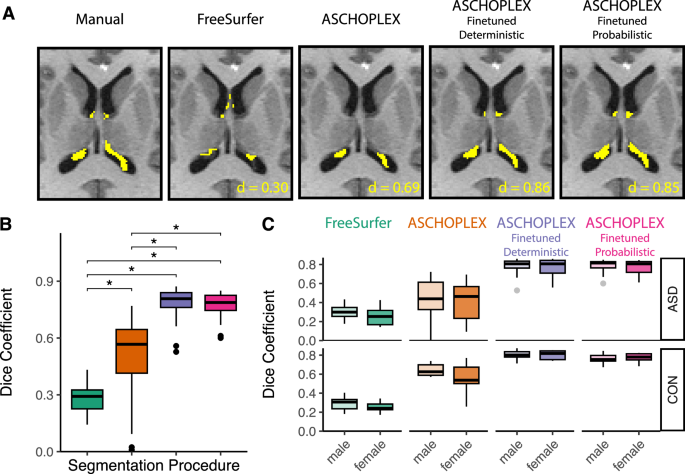 Fig. 3: Example of the choroid plexus segmentation for an individual subject from the local dataset for each of the methods.