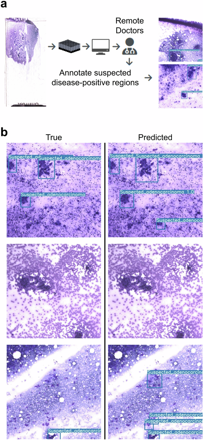 Fig. 4: Detection of suspected adenocarcinoma in lung specimens using YOLOv7.