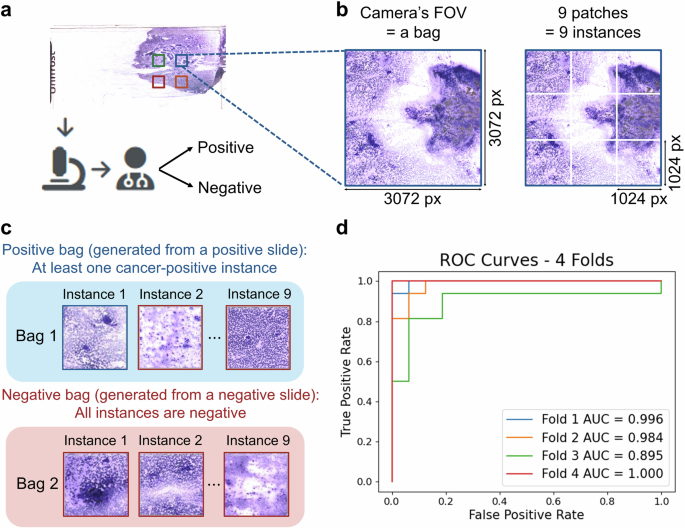 Fig. 5: Implementation of multiple instance learning (MIL) for accurate slide-level automated diagnosis.