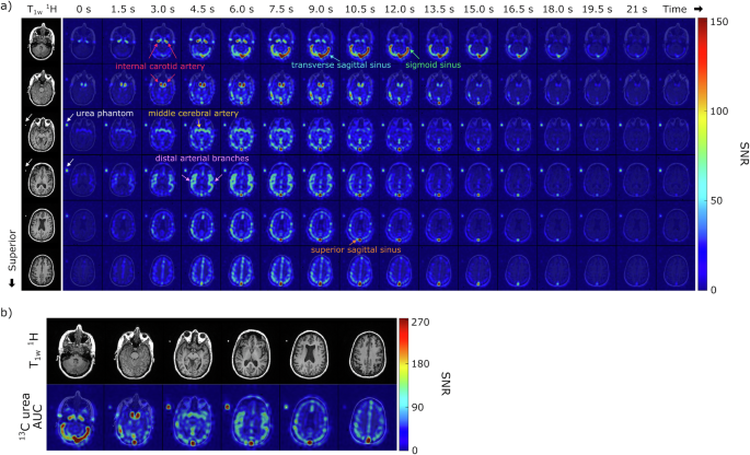 Fig. 2: Representative hyperpolarized [13C,15N2]urea images from a healthy brain volunteer.