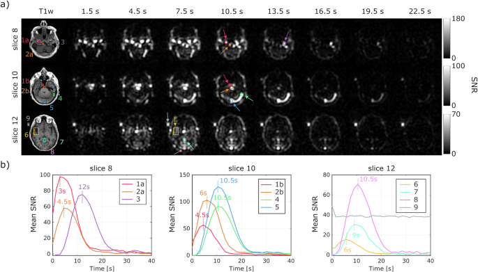 Fig. 3: Time-course analysis of hyperpolarized [13C,15N2]urea signals in a healthy brain volunteer.