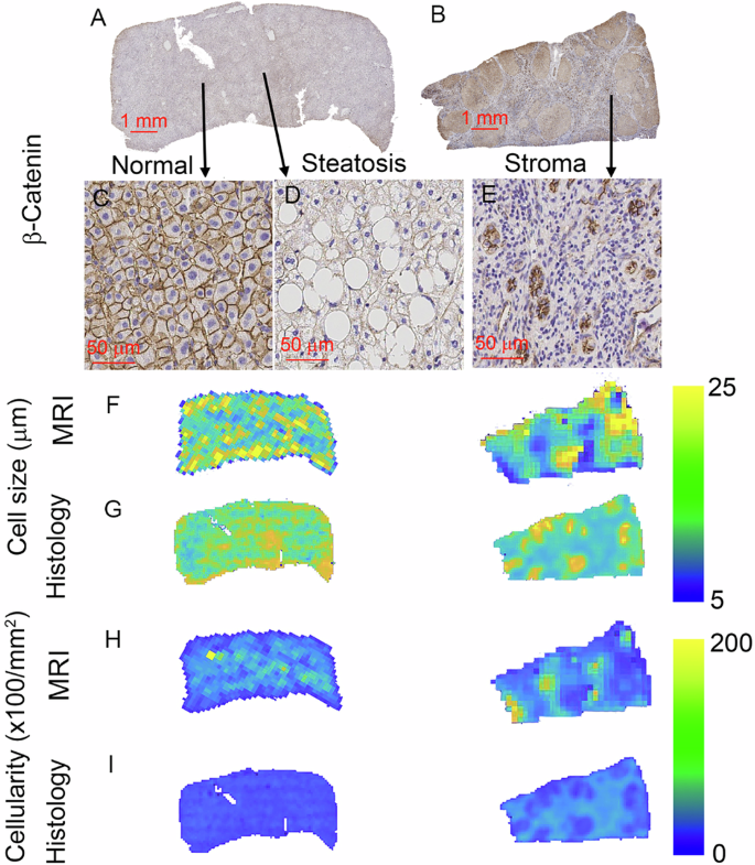 Fig. 2: Representative Cellular Maps from Histology and MRI in Fixed Human Liver Specimens.