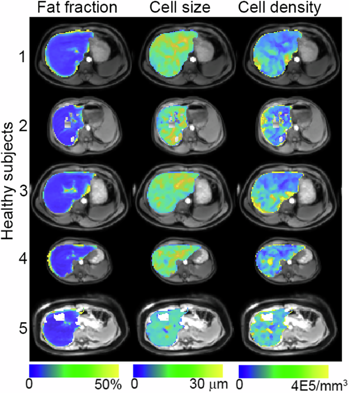 Fig. 4: Maps of MRI-derived fat fraction, cell size and cell density for five healthy subjects.