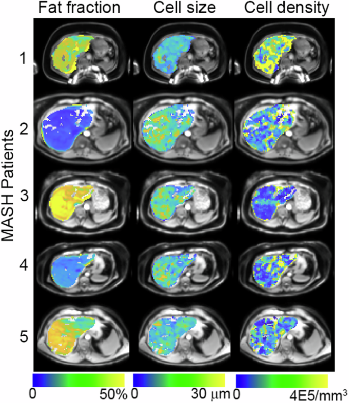 Fig. 5: Maps of MRI-derived fat fraction, cell size and cell density for five MASH patients.