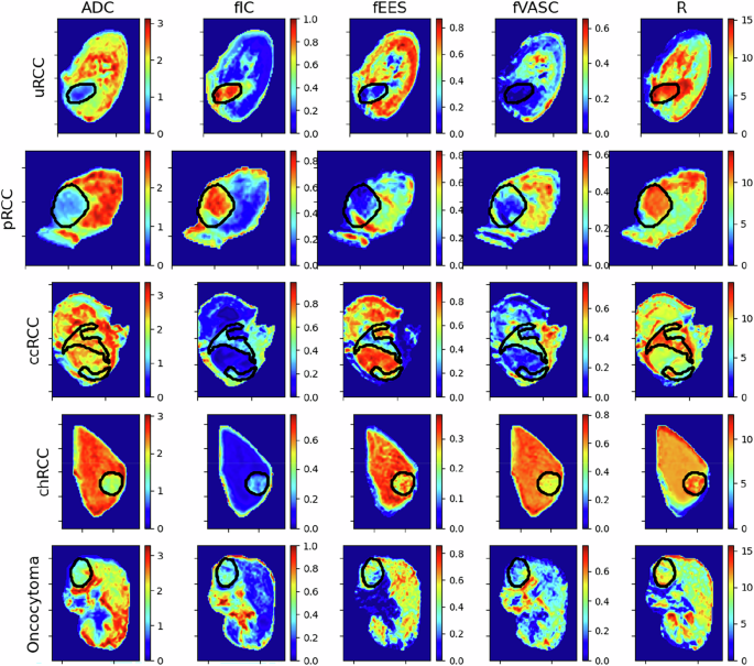 Fig. 3: Parameter maps for ADC and VERDICT parameters in all patient groups.
