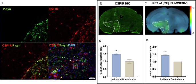 Fig. 4: Increased CSF1R level measured by IHC and PET imaging.