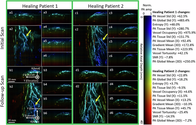Fig. 5: Longitudinal vascular changes in healing patients.